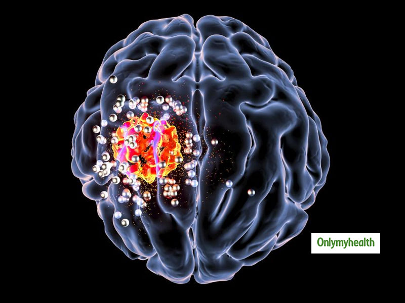 Curing Brain Cancer The 'Goldilocks' Way, Determines A Study